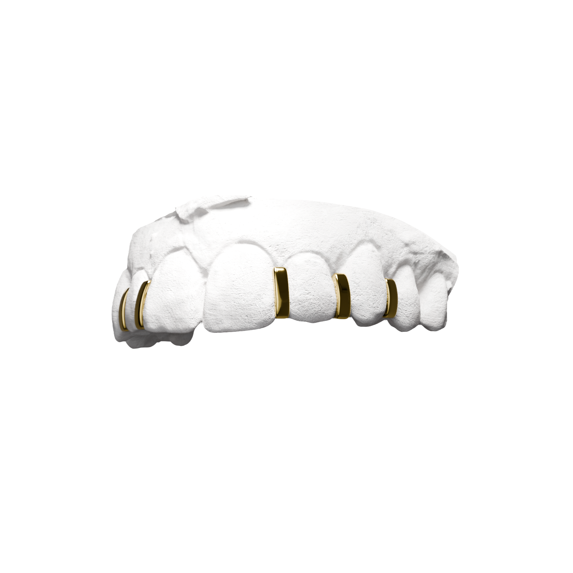 Grillz X6 Interstices – six interstices répartis sur la dentition, or, vue 3/4